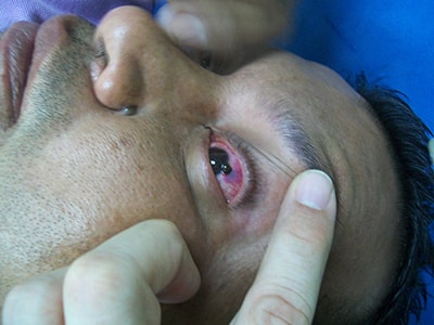 A man being treated for a penetrating eye injury from a shard of metal. This can occur if you don't wear proper eye protection while shooting.